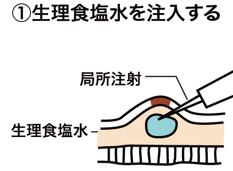 EMR(内視鏡的粘膜切除術)について