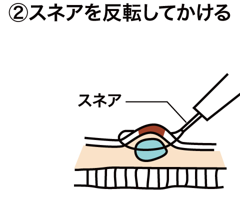 EMR(内視鏡的粘膜切除術)について