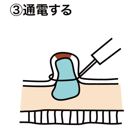 EMR(内視鏡的粘膜切除術)について